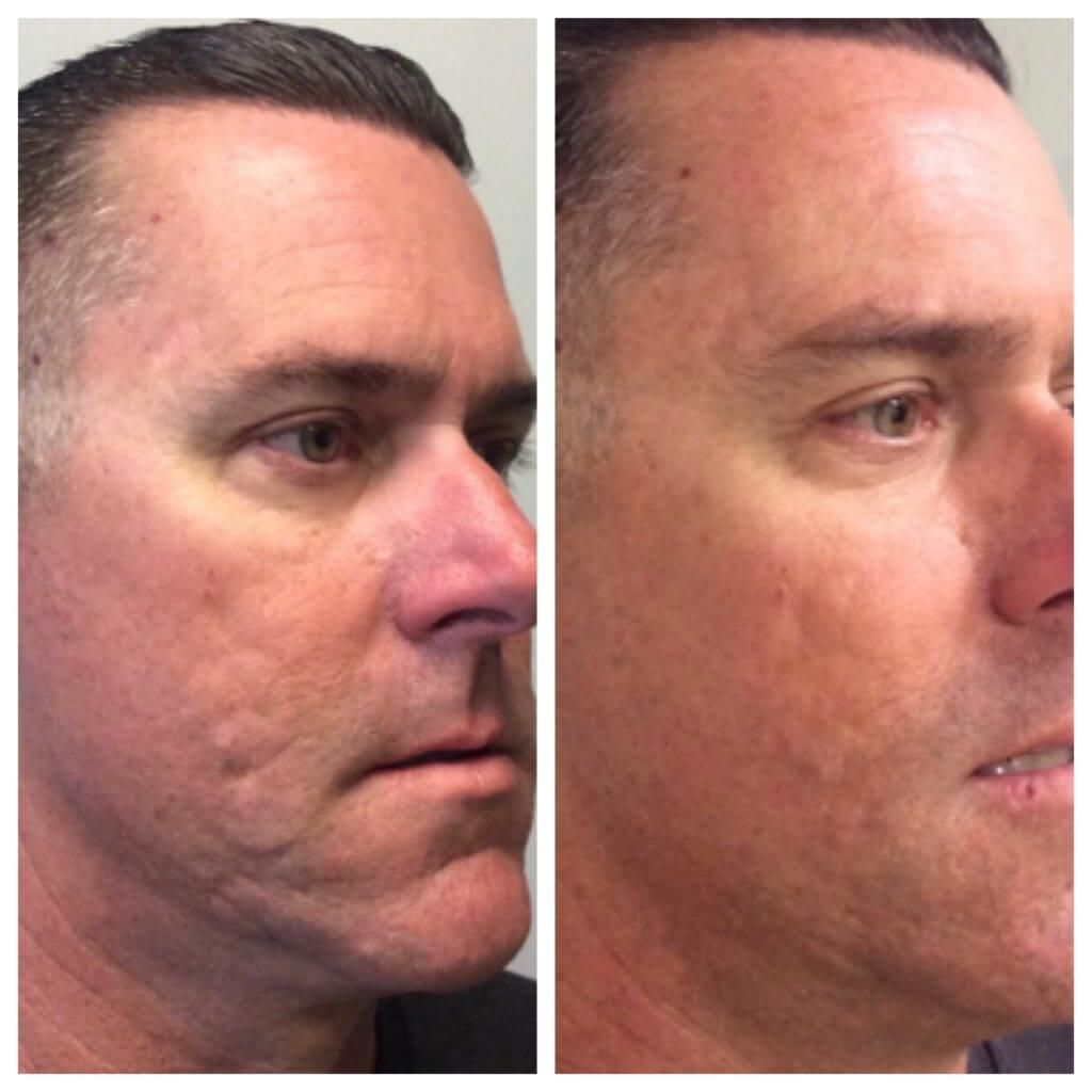 Before and after skincare treatment on male face.